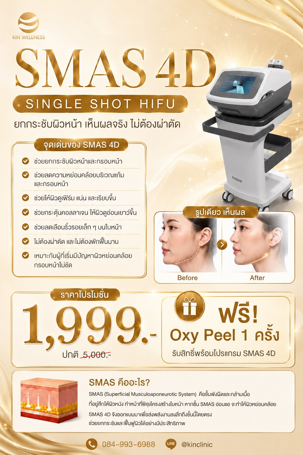 HIFU ยกกระชับใบหน้าด้วยคลื่นเสียงความเข้มข้นสูง KIN Wellness โปรแกรม HIFU ยกกระชับใบหน้า High Intensity Focused Ultrasound Promotion KIN Wellness ศูนย์ฟื้นฟูคิน KIN